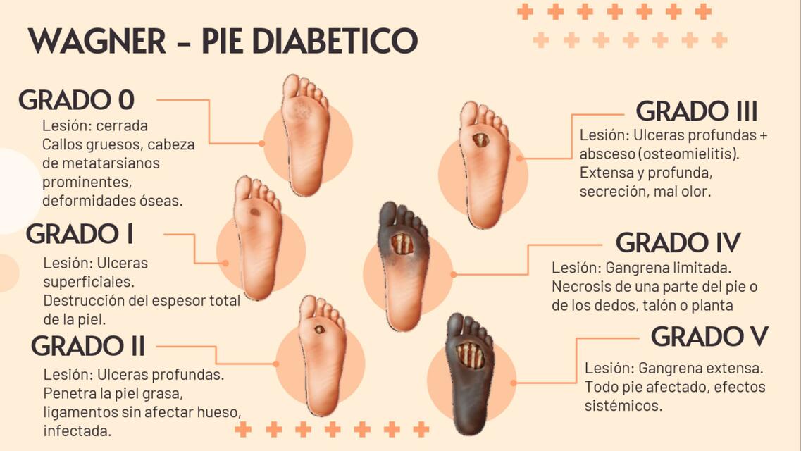 pie diabetico