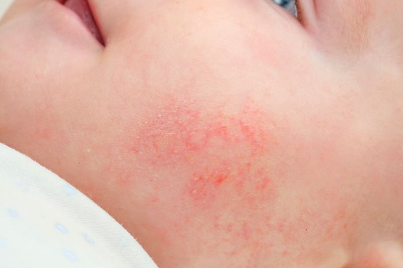 dermatitis atopica o eccema