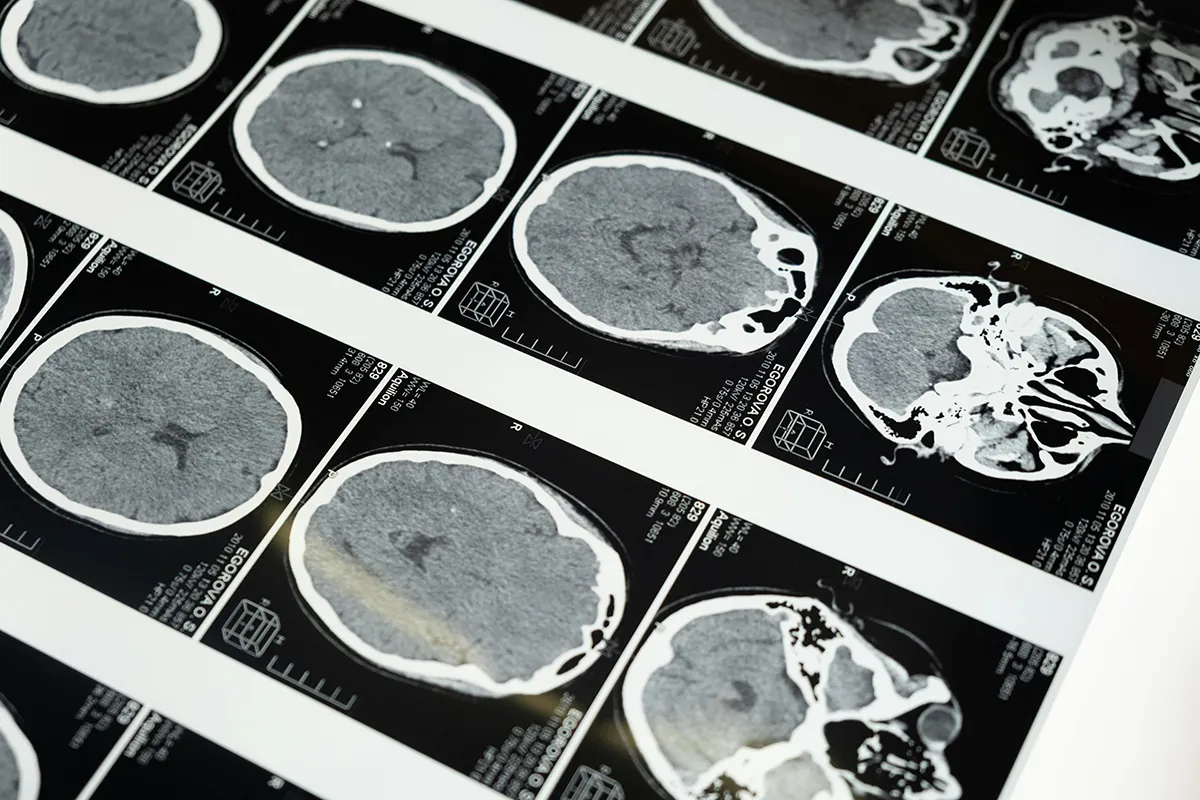 Aneurisma Cerebral
