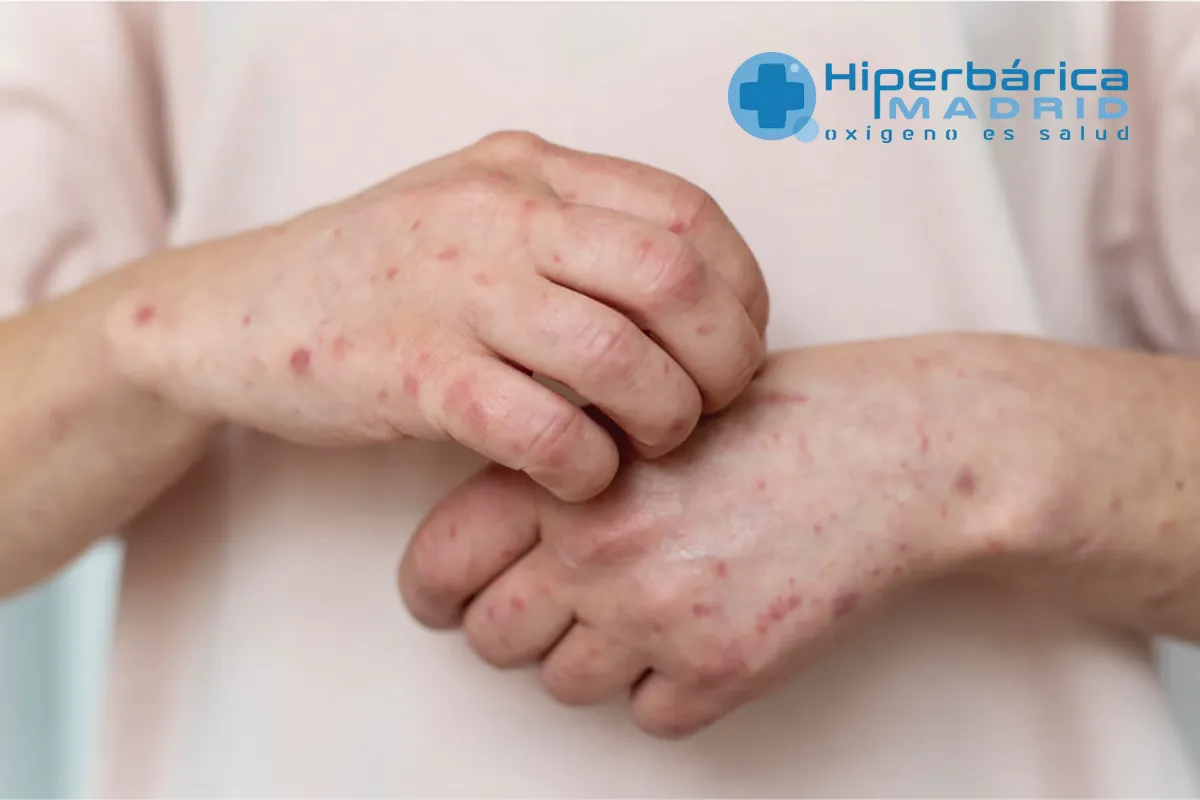 Lupus