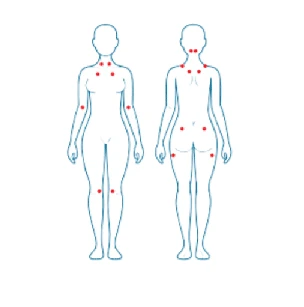 puntos dolorosos fibromialgia