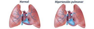 Hipertension pulmonar