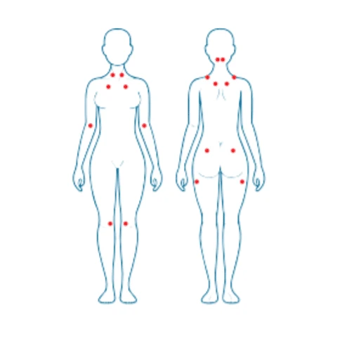 puntos dolorosos fibromialgia 1